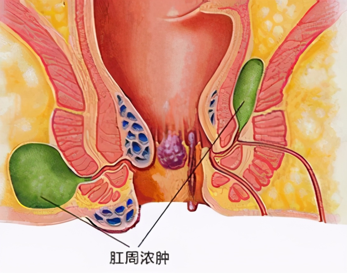 肛周脓肿会有生命危险吗,肛周脓肿手术费