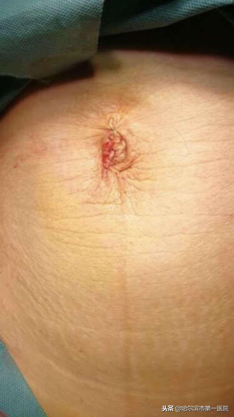 哈工大附属市一院妇二科采用单孔腹腔镜手术为患者解除病痛