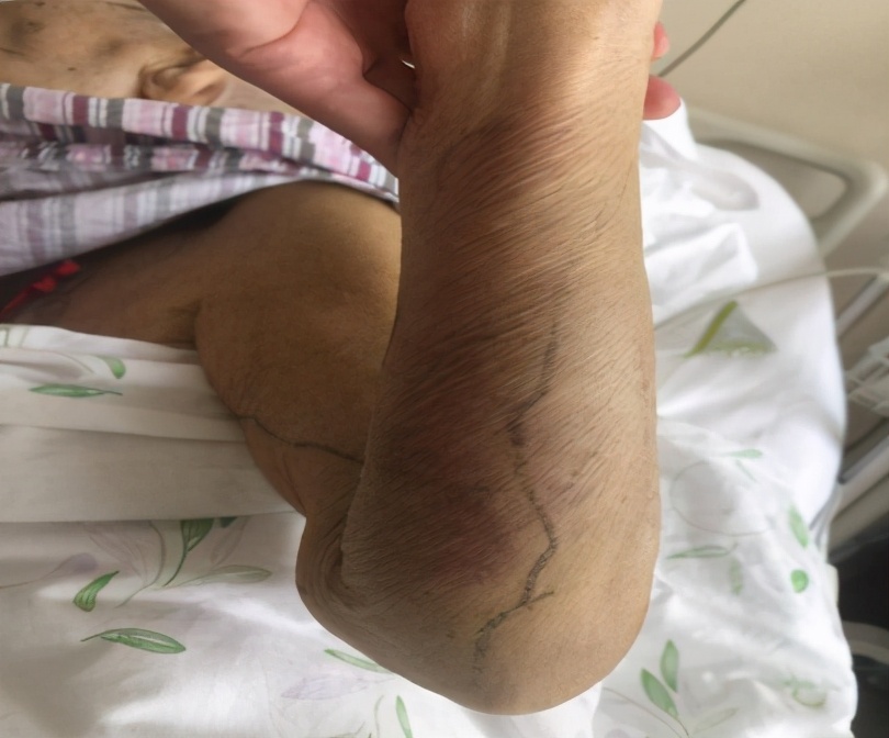 弥漫性血管内凝血属于重大疾病吗,弥漫性血管内凝血最常见的原因是