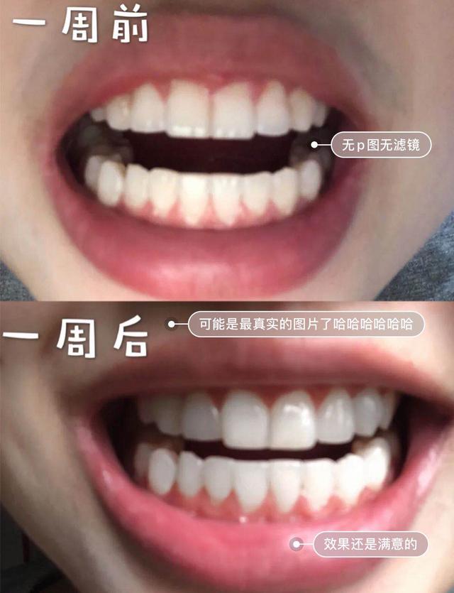 洗牙正确的刷牙方法,洗牙用什么洗牙齿才不酸