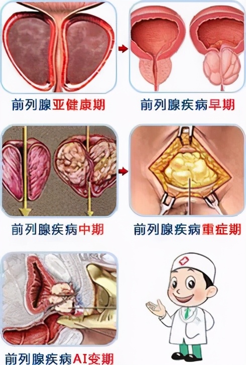 上期回忆|正视男性前列腺炎，消除性功能障碍的隐患
