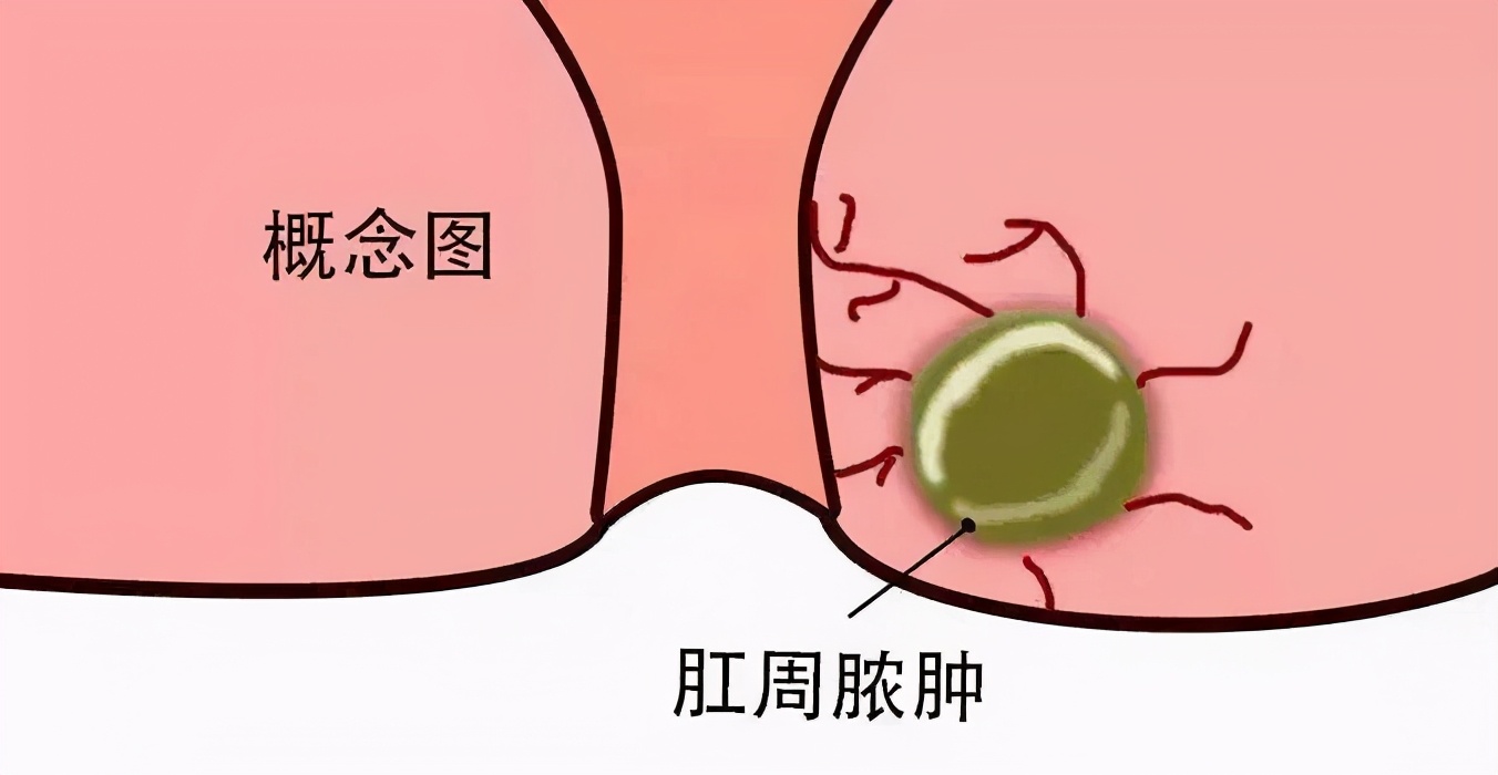 屁股痤疮最怕的克星,屁股痛的克星