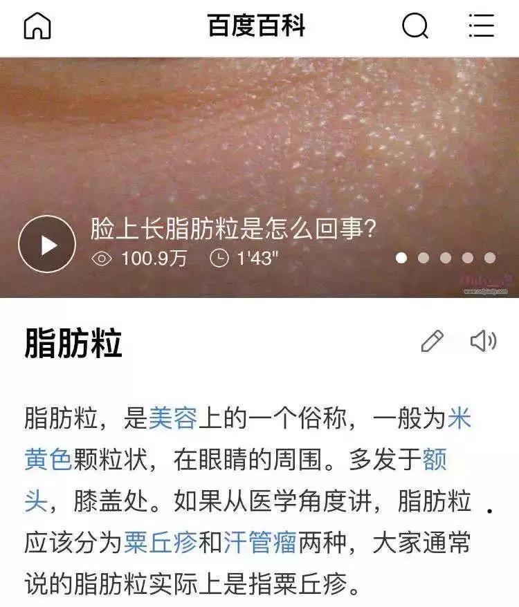 黑头闭口粉刺怎么去除,黑头粉刺怎么去都消除不了