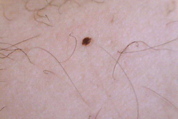 如何避免黑痣变成黑色素瘤,黑痣与黑色素瘤到底怎么区分