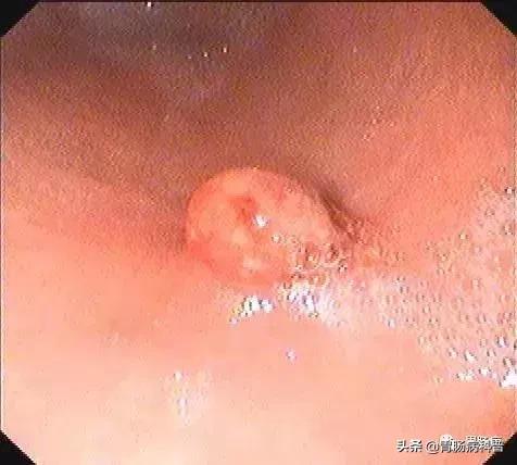 为什么胃息肉会癌变,如何判定胃息肉有没有癌变