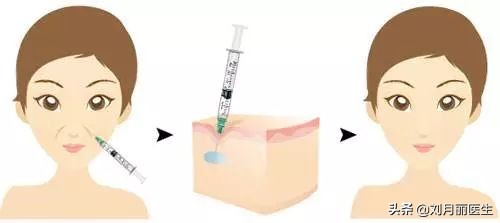 修复苹果肌改善法令纹,改善法令纹的面部运动