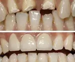 怎么才能真正有效的美白牙齿,最快最有效美白牙齿的方法