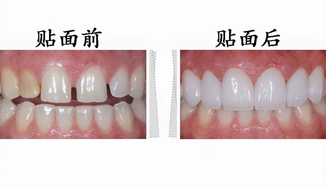 牙黄怎么办教你一招美白不花钱,如何解决牙黄最快最简单的方法