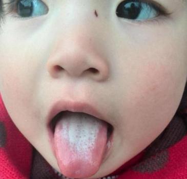 孩子吃多了积食怎么办,孩子容易积食内热怎么办