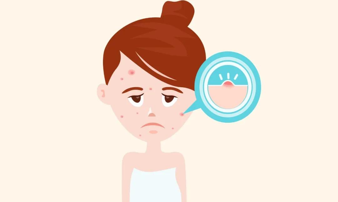 如何祛痘印,如何祛痘印男生