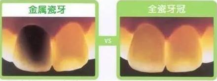 戴烤瓷牙有没有什么后遗症,全烤瓷牙有什么风险和后遗症