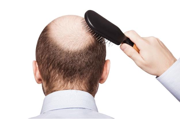 贝克汉姆脱发,贝克汉姆被曝脱发角度问题