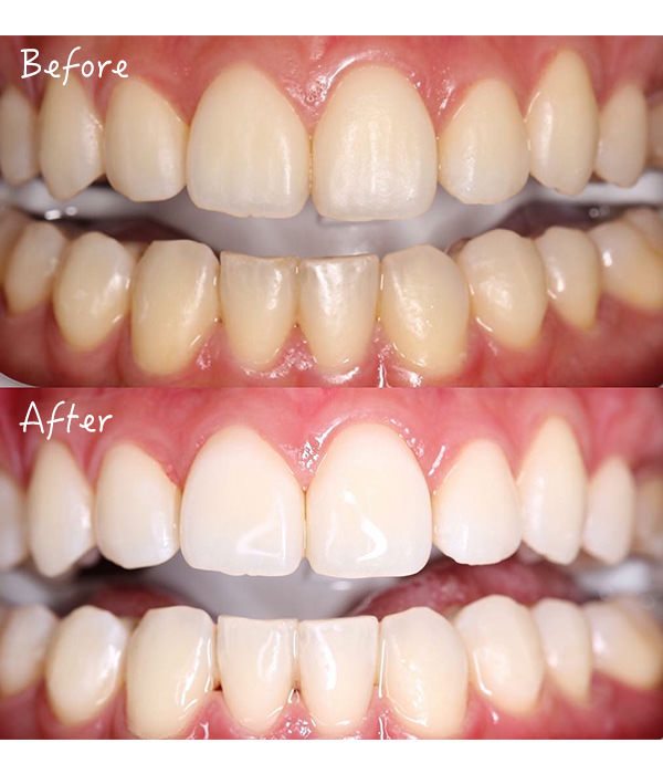 牙齿美白有这几种方法你了解多少,牙齿美白靠谱吗十年牙医告诉你