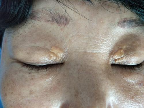 眼睛角长了个睑黄瘤是什么东西,眼睑附近长的淡黄色的睑黄瘤