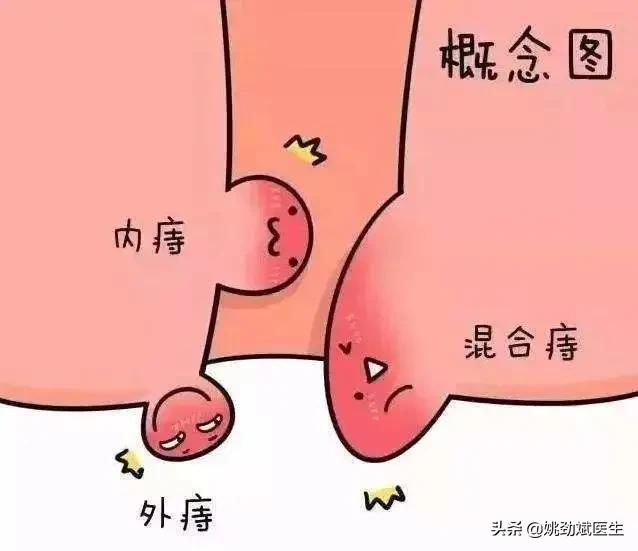 痔疮科普简单易懂,痔疮手术后形成血栓外痔怎么办