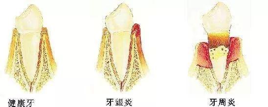 牙龈炎牙周炎牙髓炎怎么区别,牙周炎与牙髓炎牙龈炎有什么区别