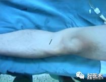 治疗肩锁关节脱位，有最好的方法吗？