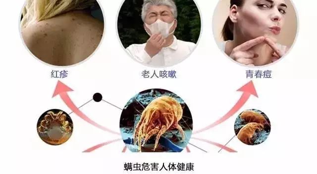 身上长痘、哮喘鼻炎可能都是螨虫惹的祸！除螨用这招，螨虫死光光