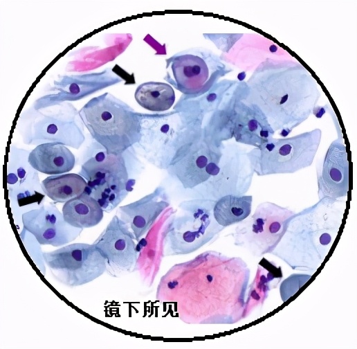 TCT、阴道镜、CIN、锥切（leep）都是什么意思？