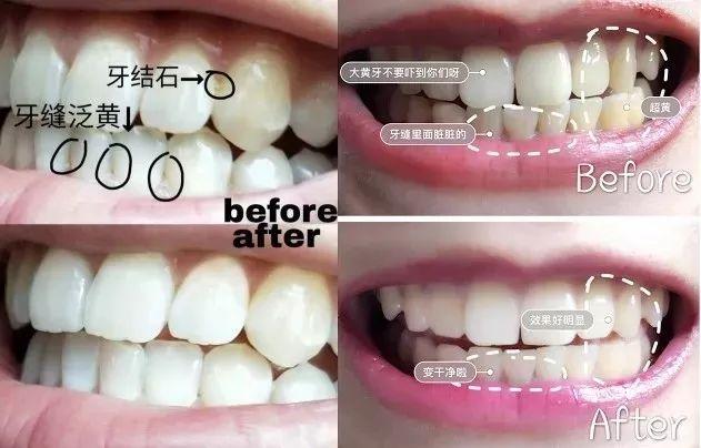 刷牙黄牙变成白牙怎么办,怎么刷牙才会让黄牙变成白牙