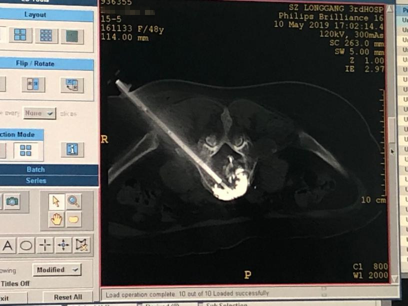 凸显“三院微创”品牌，龙岗三院再次填补肿瘤微创介入治疗空白