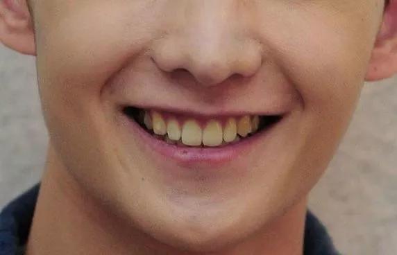 牙齿美白六种实用方法,牙齿美白的三种新方法