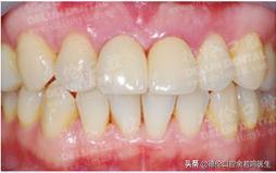 里面的牙如何修复,现在哪里有修复牙齿的