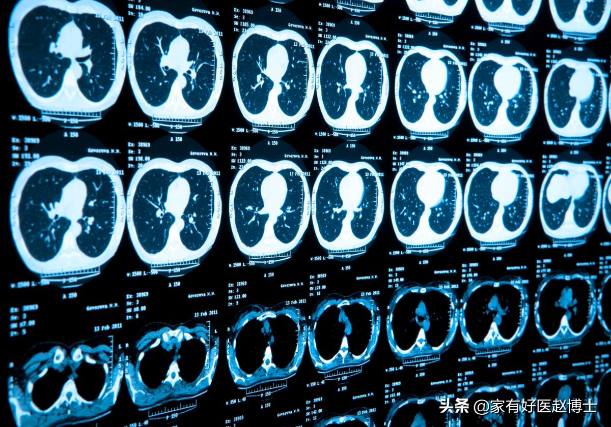 体检报告中常出现钙化哪些需警惕,钙化有什么症状和危害