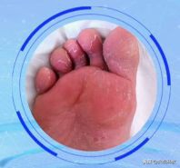 灰指甲足癣有什么偏方,灰指甲脚气湿疹