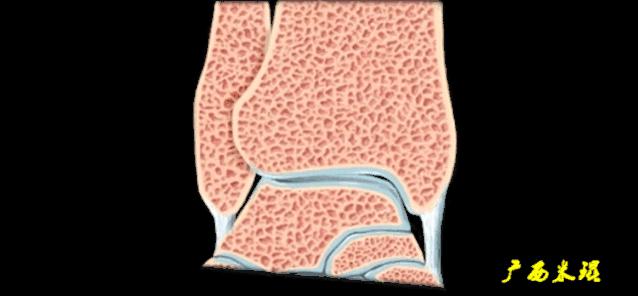 为什么踝关节扭伤容易崴脚,崴到脚踝关节扭伤怎么处理好得快