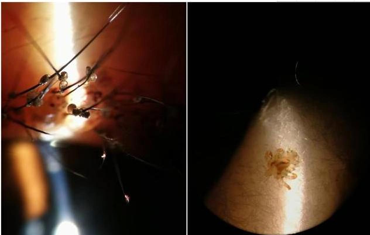 虱子童年回忆,20年前的虱子为什么消失了科普