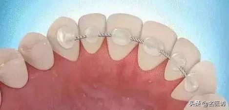 隐形矫正结束后要戴多久保持器,儿童矫正牙齿后要戴多久保持器