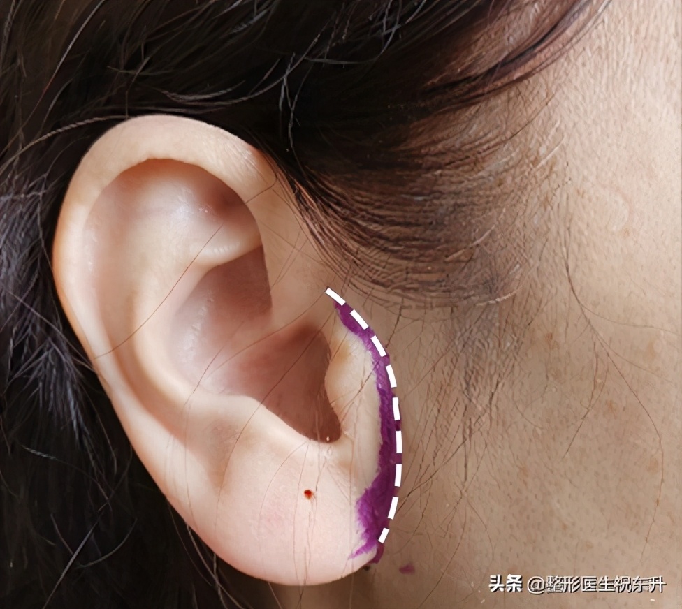 拉皮手术后必须用疤克吗,不做拉皮手术会留疤吗