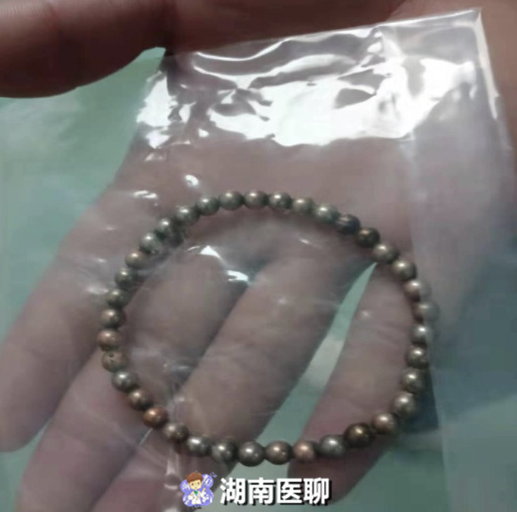 孩子吞食磁珠会穿孔吗,4岁女孩吞61颗磁力珠14处肠穿孔