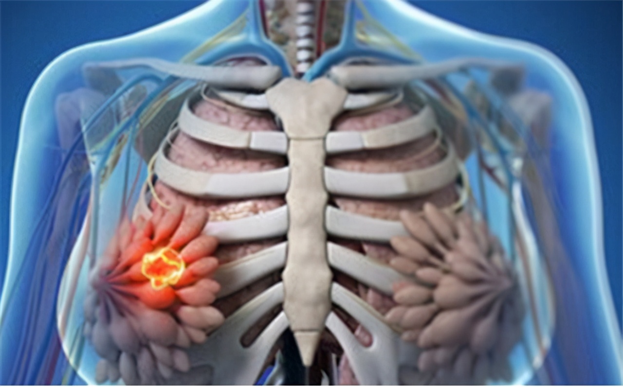 乳腺囊肿和结节哪一个容易癌变,乳腺囊肿在怀孕期会癌变吗