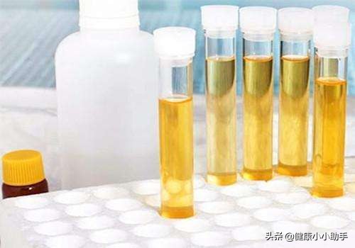尿液出现6种颜色要当心,尿液出现这4种颜色你就要当心了