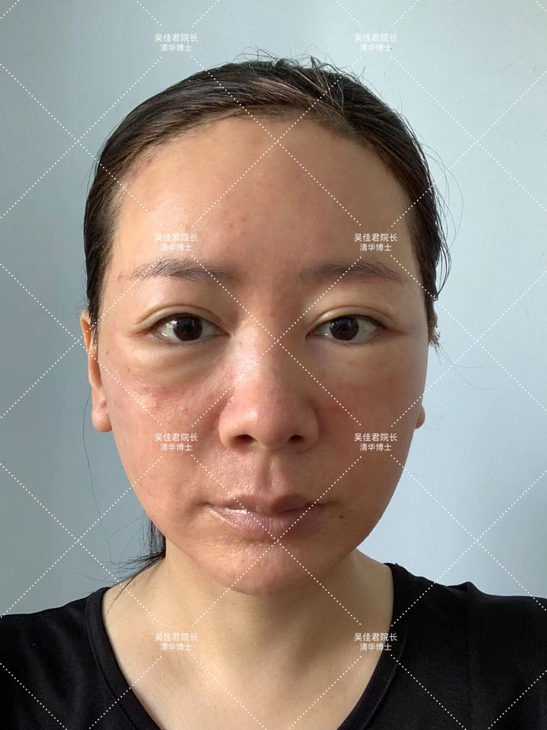 大拉皮术后50天真实感受,拉皮手术5年之后的变化