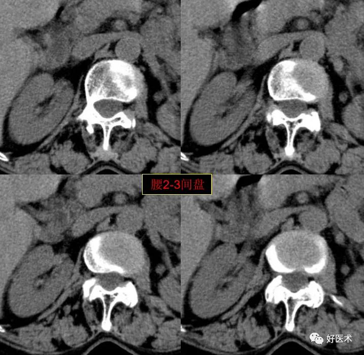 腰部ct需要注意事项,做腰部ct需要注意的事项
