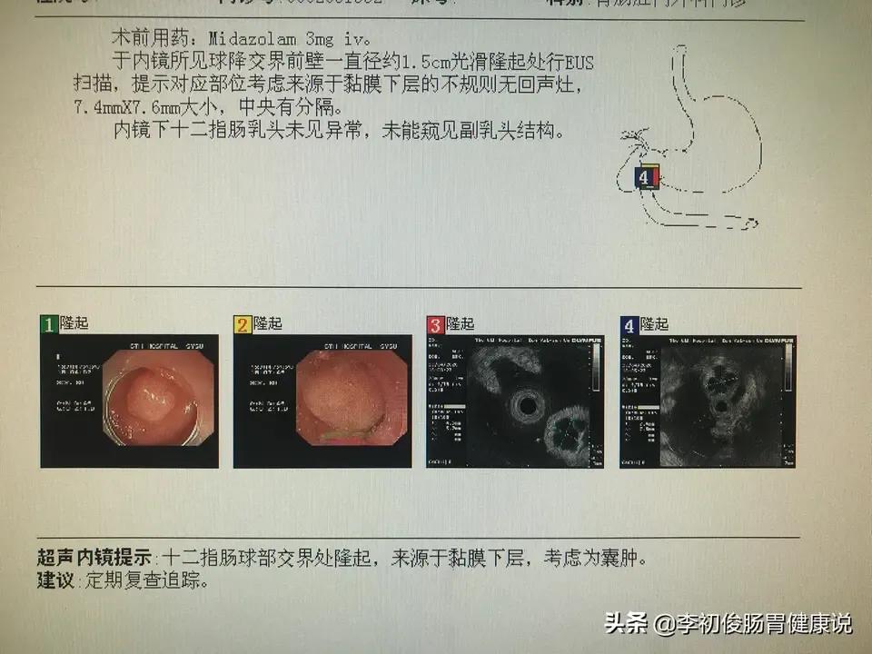 很高兴，又将一位患者“赶”回家！无需住院，无需手术！