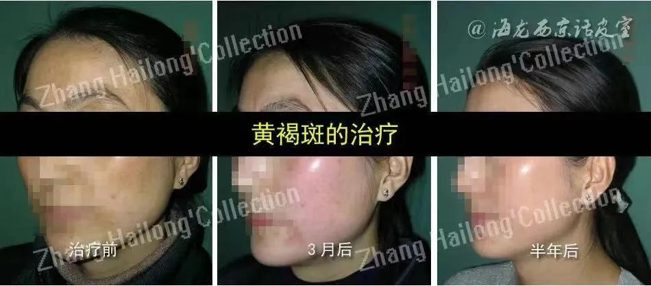 平安树褐斑黄叶怎么治疗,褐斑穿孔病的症状和治疗