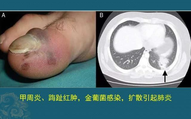 化脓性肺炎，硬扛3天不吃抗生素必后悔，这个细菌专治各种不服