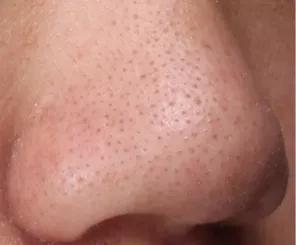 面部毛孔粗大有黑头在家怎么去除,面部暗黄毛孔粗大出油是什么原因