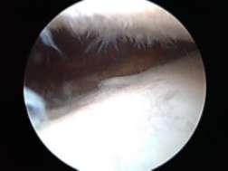 膝关节肿胀变形的照片,膝关节疼痛还可以运动吗