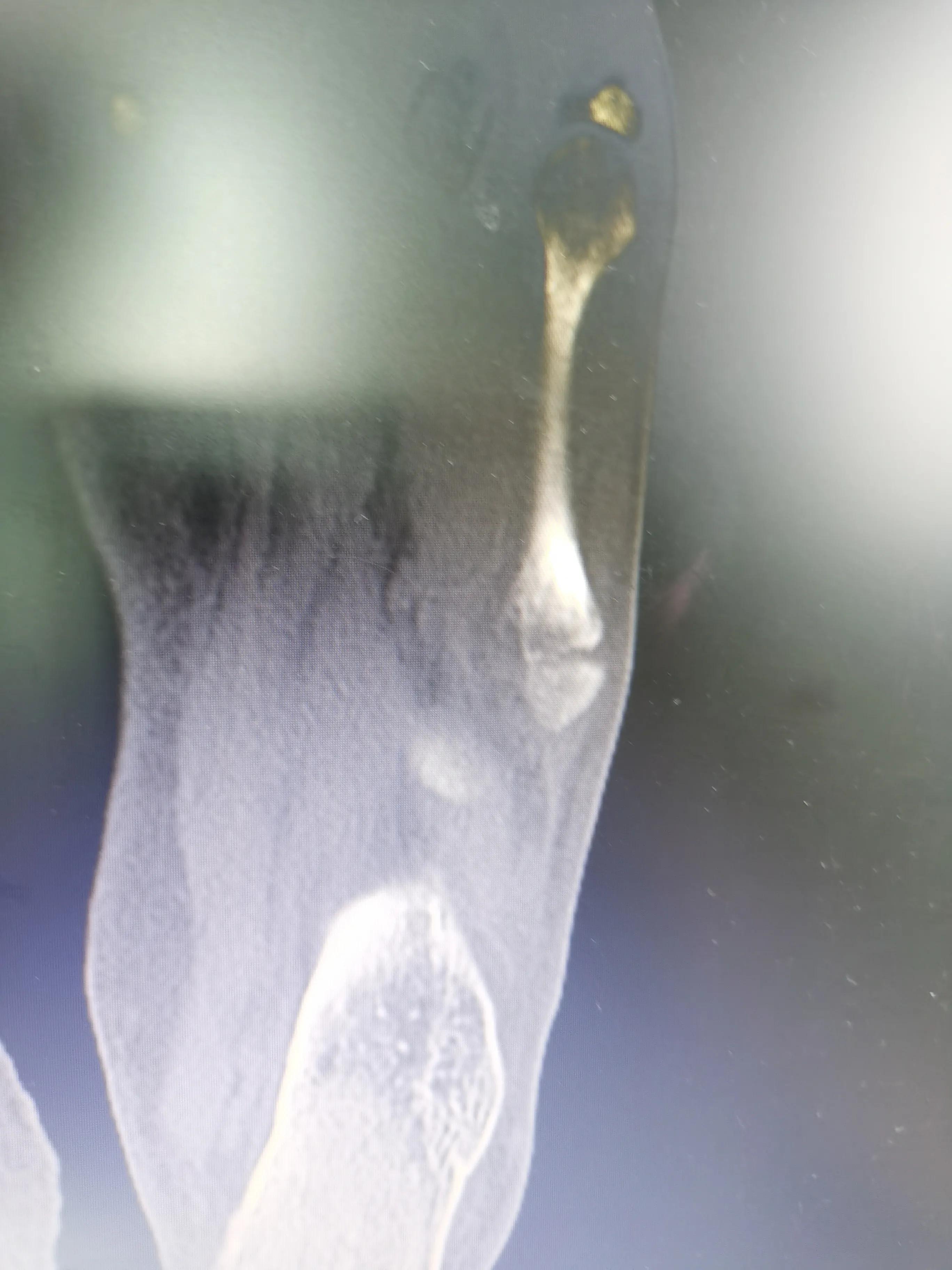 第五跖骨粉碎性骨折多久后能走路,第五跖骨基底骨折100天了走路肿