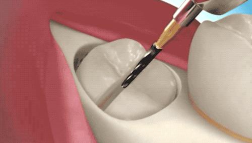 拔智齿是怎么算收费的,拔智齿是按智齿个数收费吗