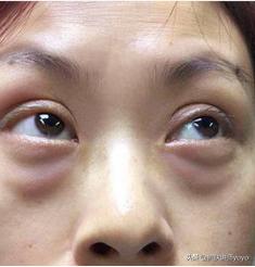 眼霜哪种好用不长脂肪粒,哪些眼霜抹了不长脂肪粒