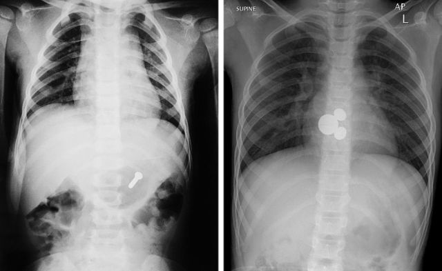 x射线下的人体图,x射线照片