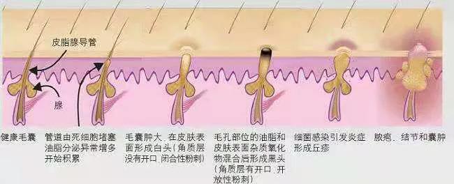 怎么解决糟心的黑头,怎么才能看清楚自己脸上的黑头