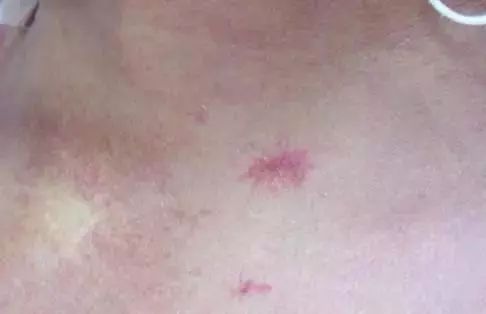 身上出现红色痣一定与肝脏有关吗,出现痣警惕肝脏病变