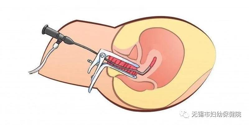 宫腔镜女性的福音先进设备,妇科宫腔镜新技术